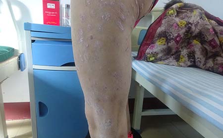 银屑病患者身上出现瘙痒症状时如何才能缓解