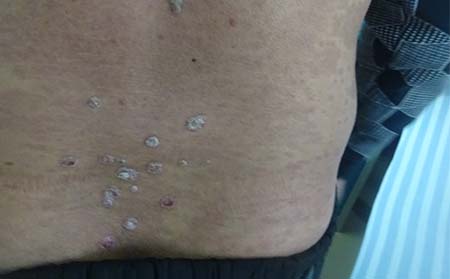 关节型牛皮癣患者在治疗要注意些什么