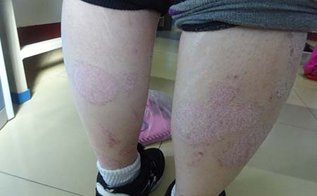 寻常型银屑病要怎样去科学调理