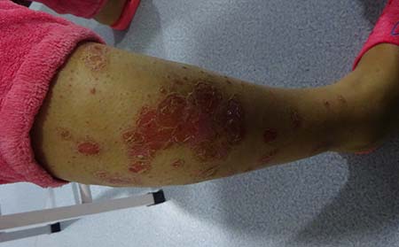 治疗银屑病哪些方法良有效