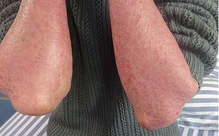 银屑病的护理方方法有什么