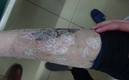 银屑病应该怎么护理