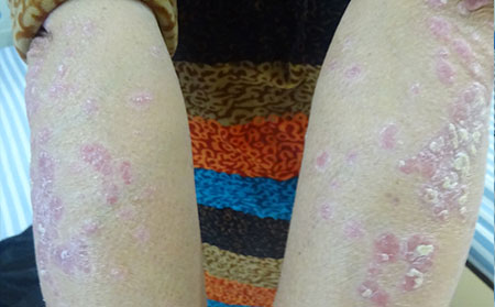 银屑病应该怎么治疗