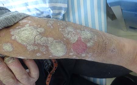 导致银屑病的原因有什么