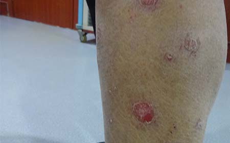 银屑病为什么加重