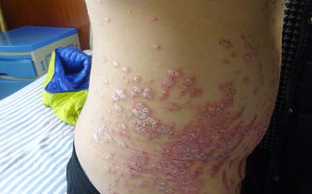 导致银屑病的原因有什么