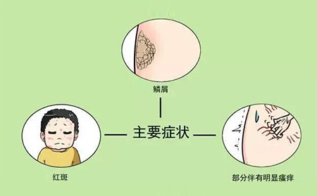 银屑病的症状有什么