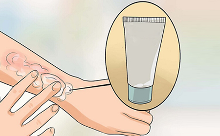 什么样的症状是银屑病