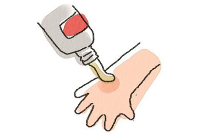 银屑病发生时的症状有什么