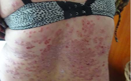 为什么会发生银屑病