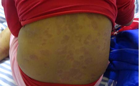 导致银屑病的原因有什么