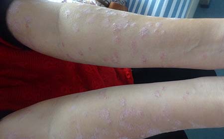 导致银屑病的原因有什么