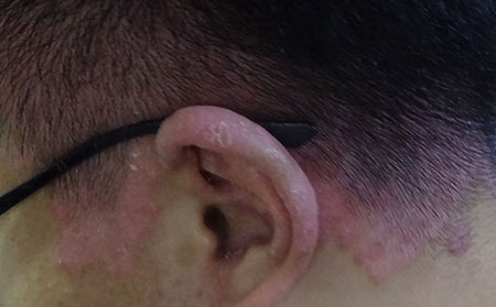 银屑病会发生在那些人身上