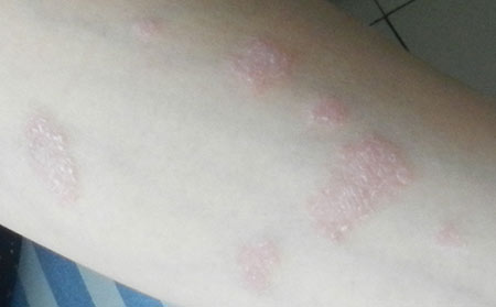 银屑病有什么症状