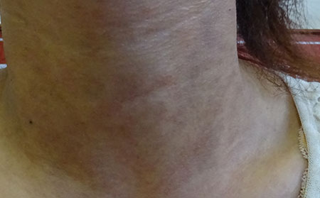 导致寻常型银屑病恶化的原因是什么