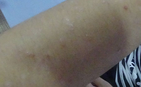 银屑病应该怎么护理