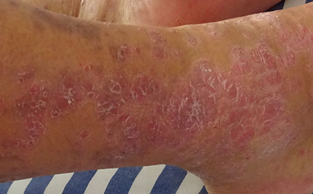 银屑病发生的病因有哪些呢