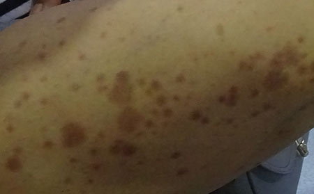 银屑病应该怎么科学止痒