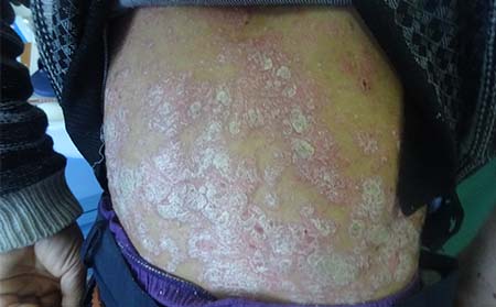 潍坊银屑病反复的原因