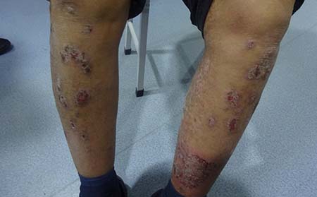 银屑病应该怎么预防