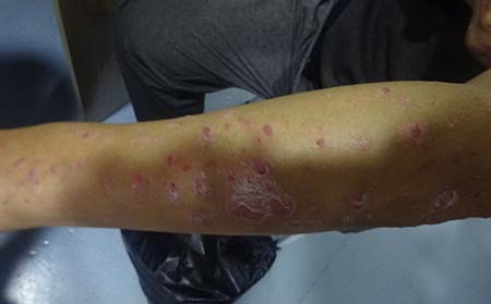 潍坊导致银屑病的原因有什么