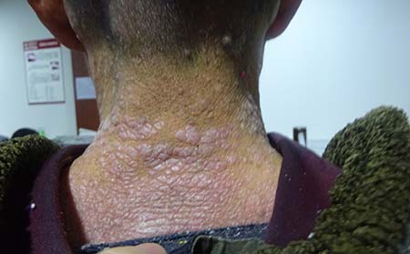 银屑病病因,潍坊东方银屑病研究院,潍坊银屑病的皮肤病医院