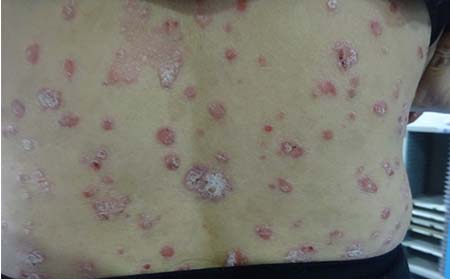 牛皮癣病因,银屑病病因,潍坊银屑病哪个医院好