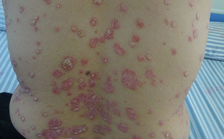 银屑病病因,冬季银屑病病因,潍坊银屑病医院的治疗方式