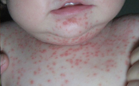 潍坊牛皮癣医院哪家好儿童得牛皮癣病因