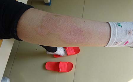 潍坊银屑病医院哪家好冬季银屑病治疗