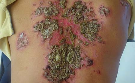 潍坊脓疱型银屑病,脓疱型银屑病图片