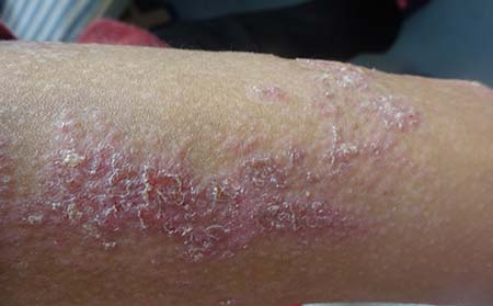 斑块型银屑病症状,斑块型银屑病图片