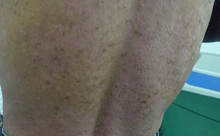 背部银屑病症状,背部银屑病症状图片