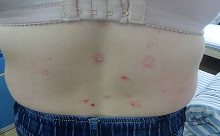 点滴状牛皮癣症状,点滴状牛皮癣图片