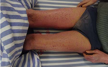 银屑病症状,红斑鳞屑银屑病症状