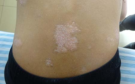 牛皮癣症状图片,牛皮癣初期症状图片