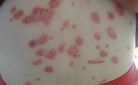 点滴状银屑病症状,点滴状银屑病图片