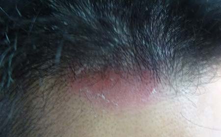 银屑病症状表现,银屑病发病症状表现