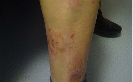 儿童银屑病症状图片,小孩银屑病图片