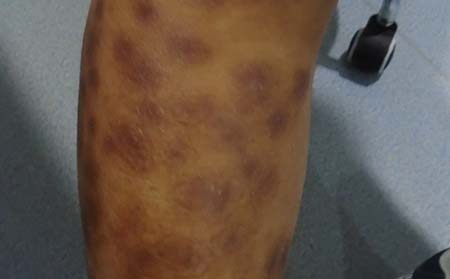 腿部牛皮癣症状,腿部牛皮癣症状图片