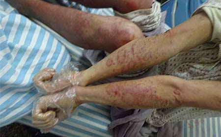 关节型银屑病症状,怎样诊断关节型银屑病