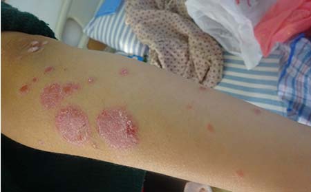 小孩牛皮癣症状,小孩牛皮癣早期牛皮癣症状