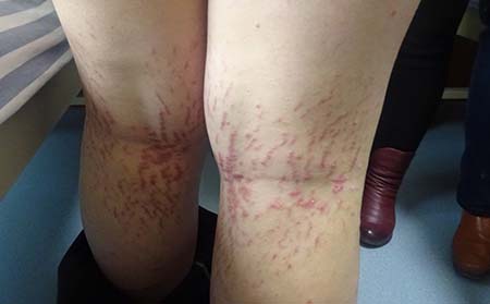 寻常型银屑病症状,寻常型银屑病典型症状