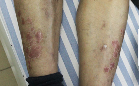 儿童银屑病病因,儿童为什么患银屑病