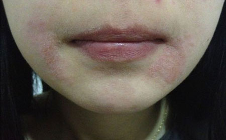 女性银屑病预防,女性如何预防银屑病
