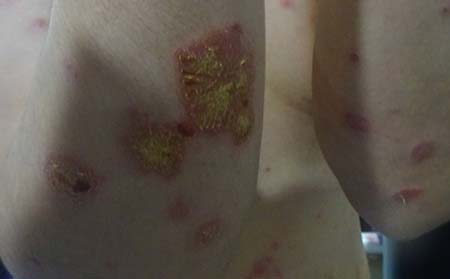 银屑病发病原因,银屑病病因