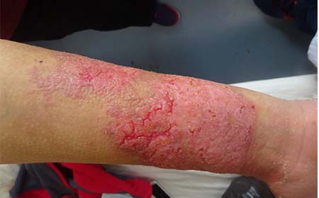 儿童银屑病病因,儿童为什么会得银屑病