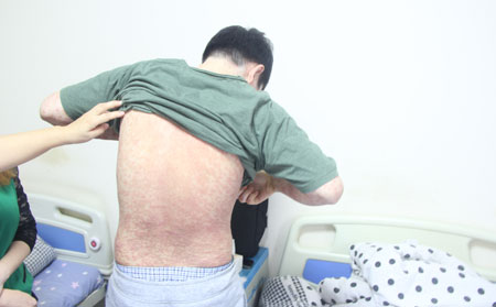 得银屑病病因,为什么身上长银屑病