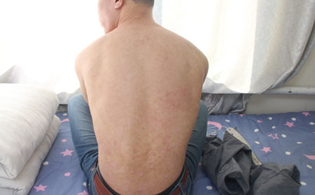 怎样控制银屑病,如何控制身上银屑病