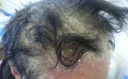 头部牛皮癣病因,头上长牛皮癣原因